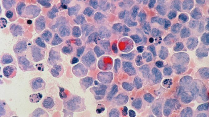 18 pacientes, todos curados: la prometedora pastilla experimental contra la leucemia más agresiva
